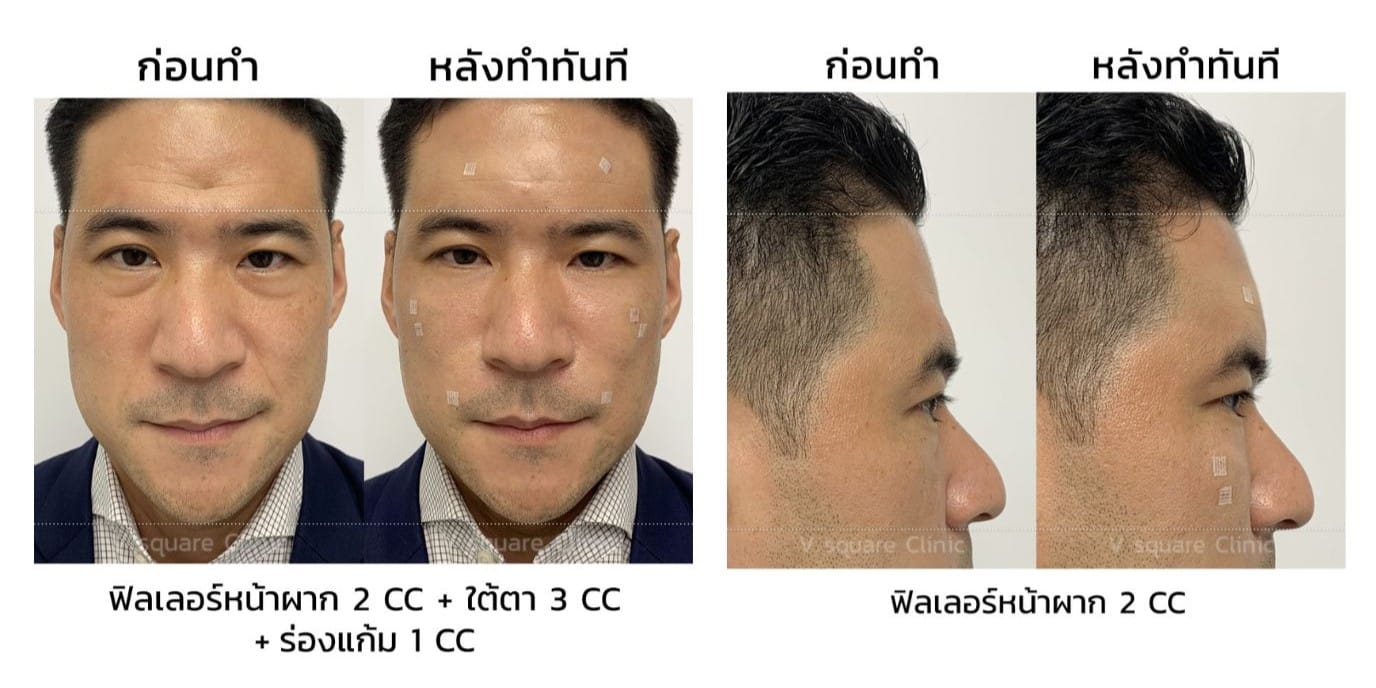 รีวิวฟิลเลอร์หน้าผาก_คุณวูจู