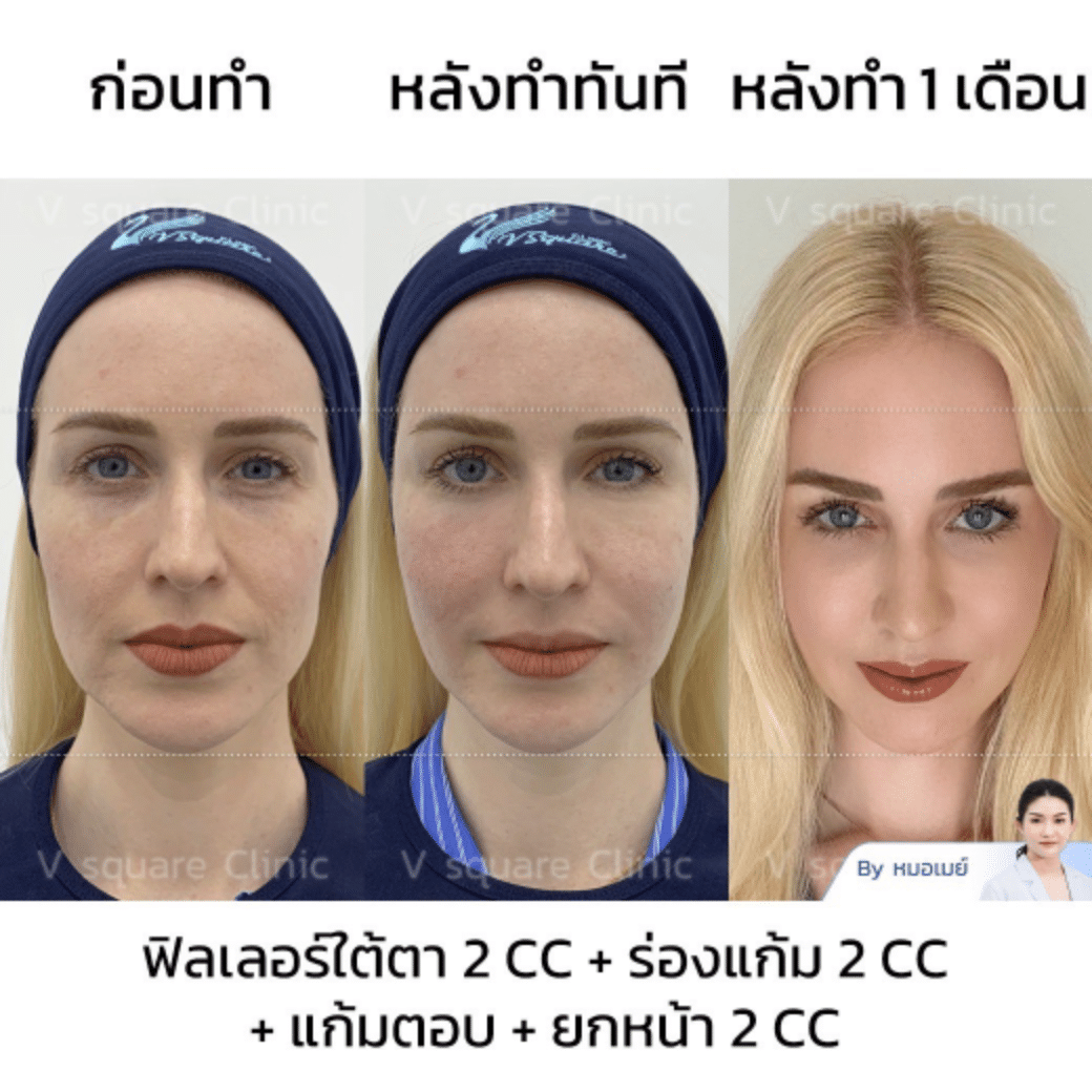 รีวิวยกกระชับใบหน้า_ครูโรซี่