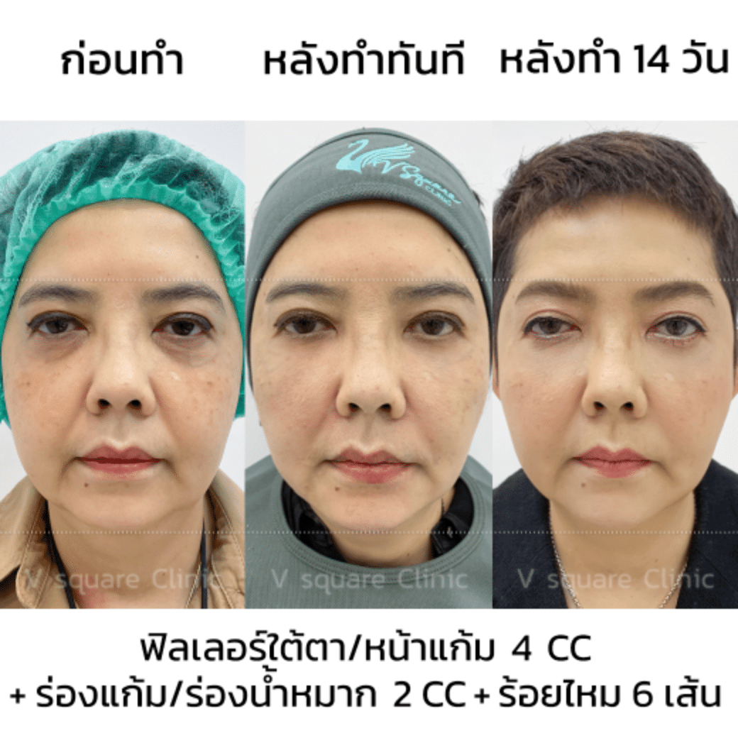 รีวิวยกกระชับใบหน้า_พี่ยุ้ยผจก.พี่ตุ้ย