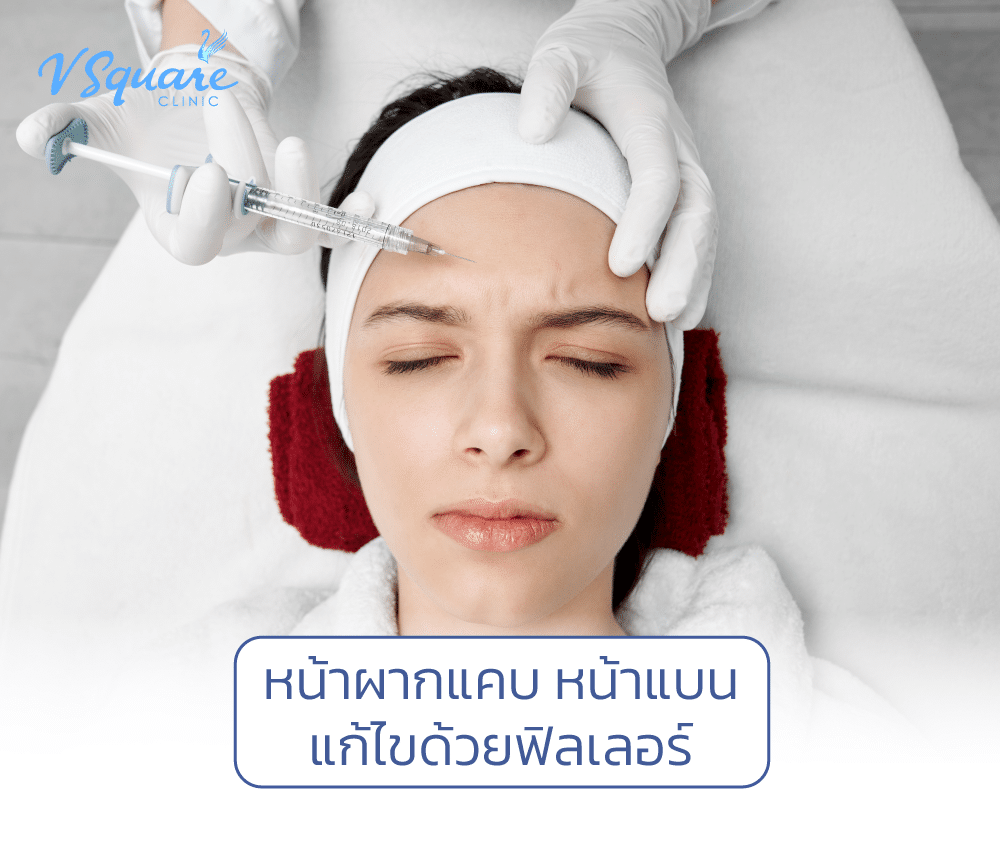 หน้าผากแคบ หน้าแบน-แก้ไขด้วยฟิลเลอร์-1000x860