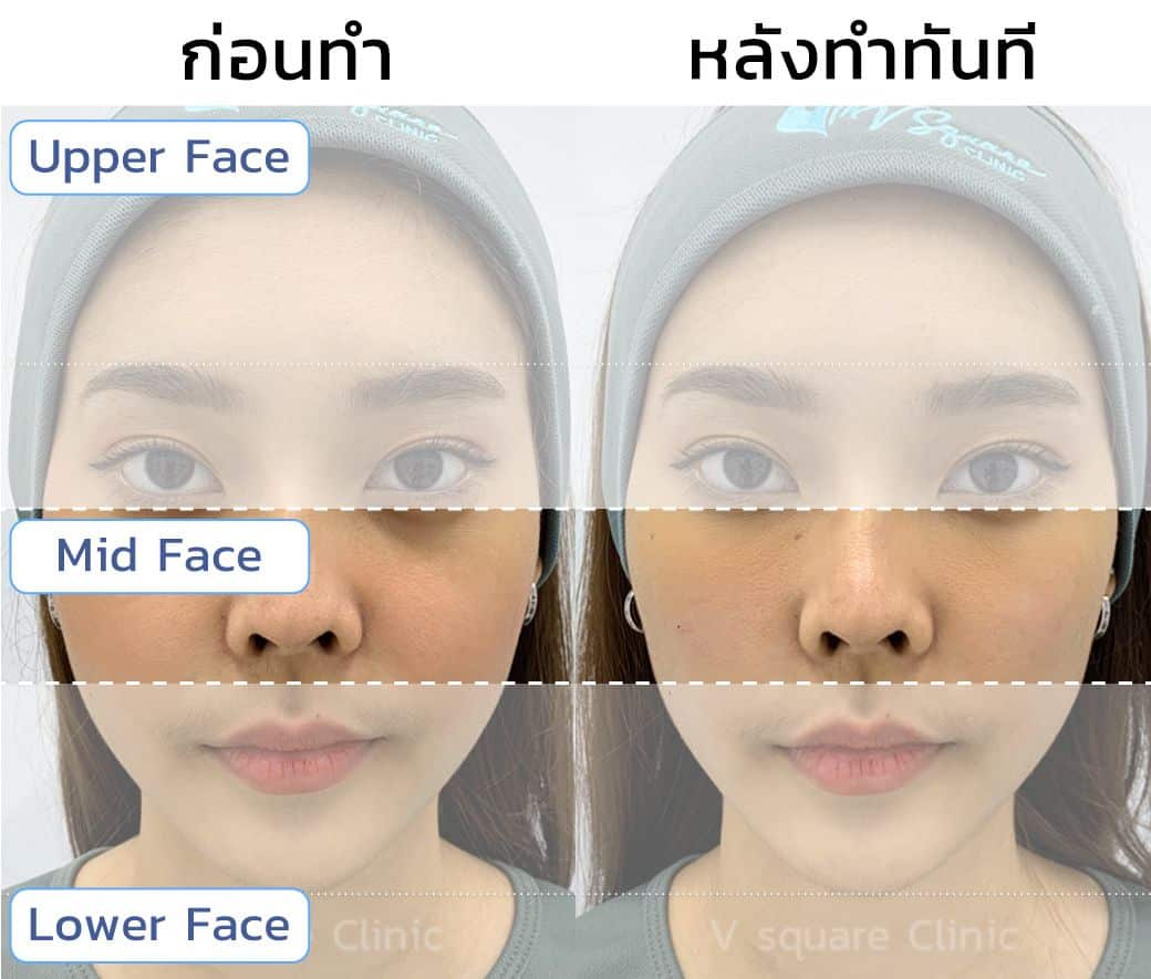 ตำแหน่ง mid face คุณฟ้า