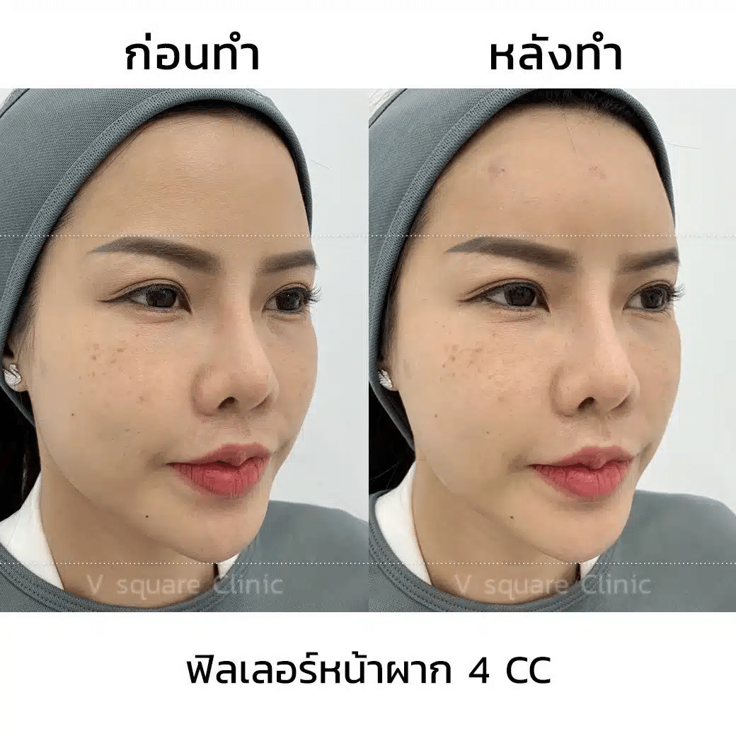 รีวิว ฟิลเลอร์หน้าผาก