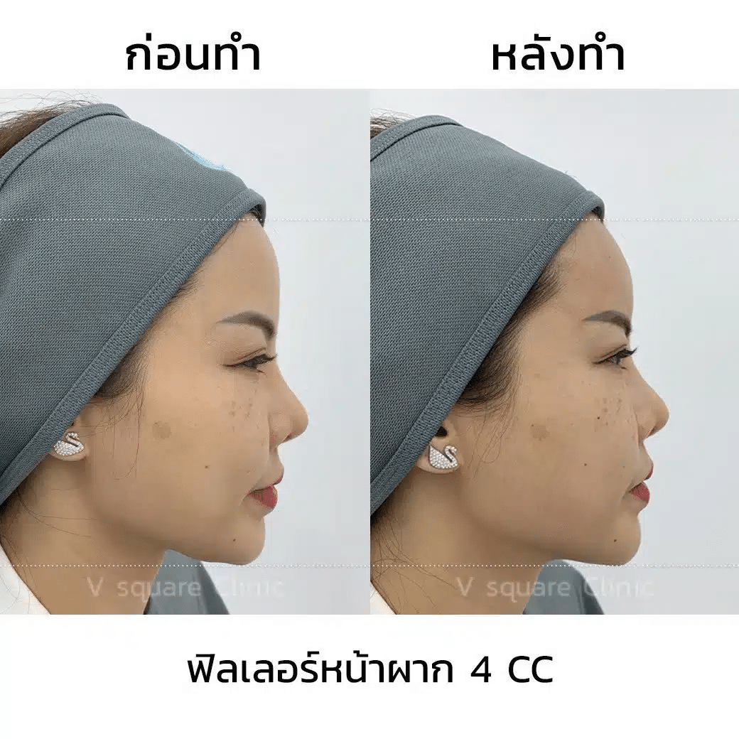 รีวิว ฟิลเลอร์หน้าผาก