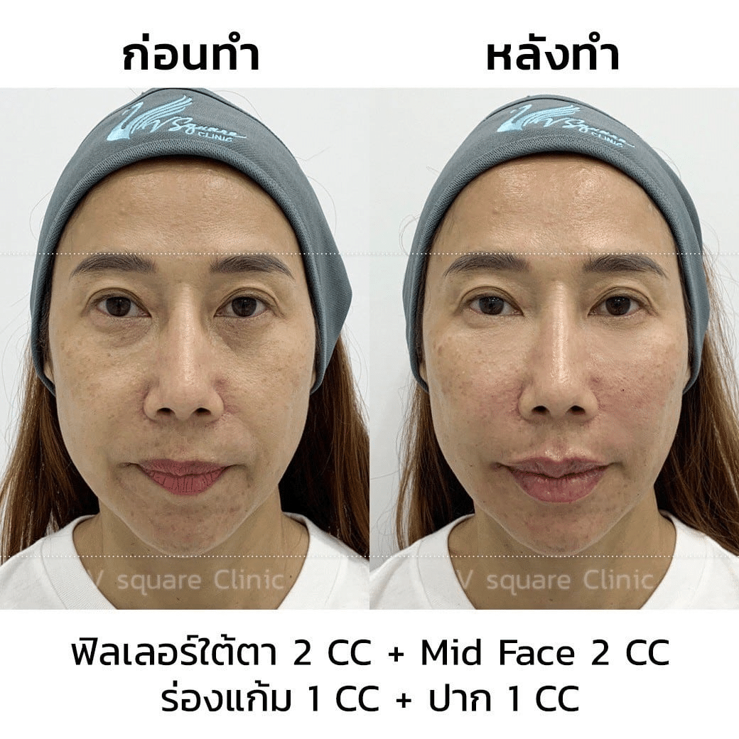 รีวิวฉีดฟิลเลอร์ mid face