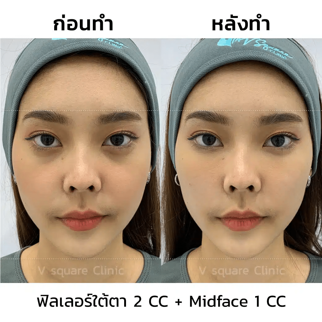 รีวิวฉีดฟิลเลอร์ mid face คุณฟ้า