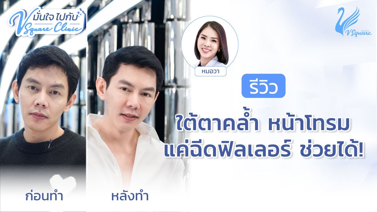 เคล็ดลับพิเศษ ฉีดฟิลเลอร์ใต้ตา ฟิลเลอร์ร่องแก้ม by หมอวา