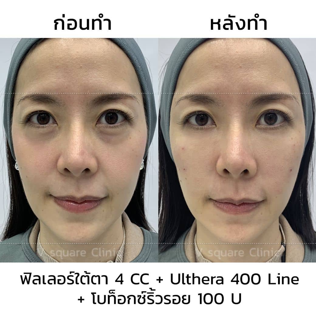 รีวิวฉีดฟิลเลอร์ใต้ตา