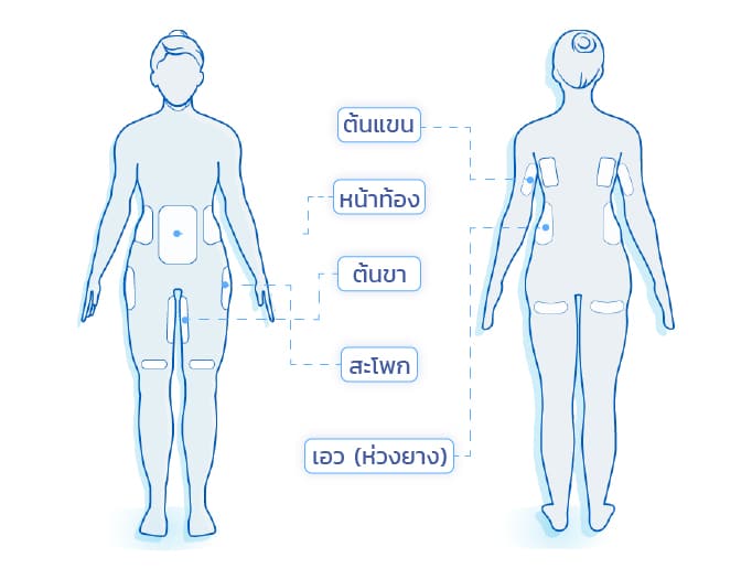 จุดทำ coolsculpting elite