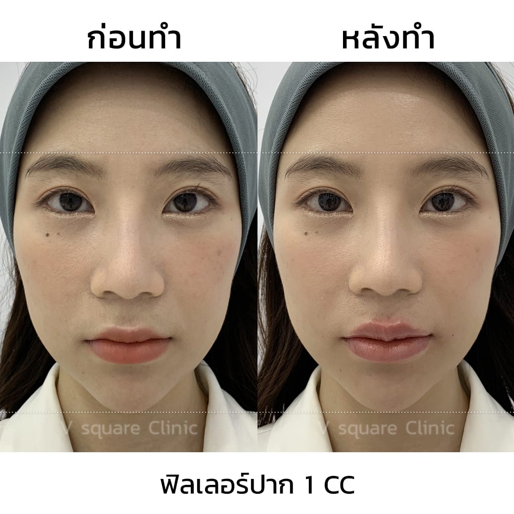 รีวิวฉีดฟิลเลอร์ปาก