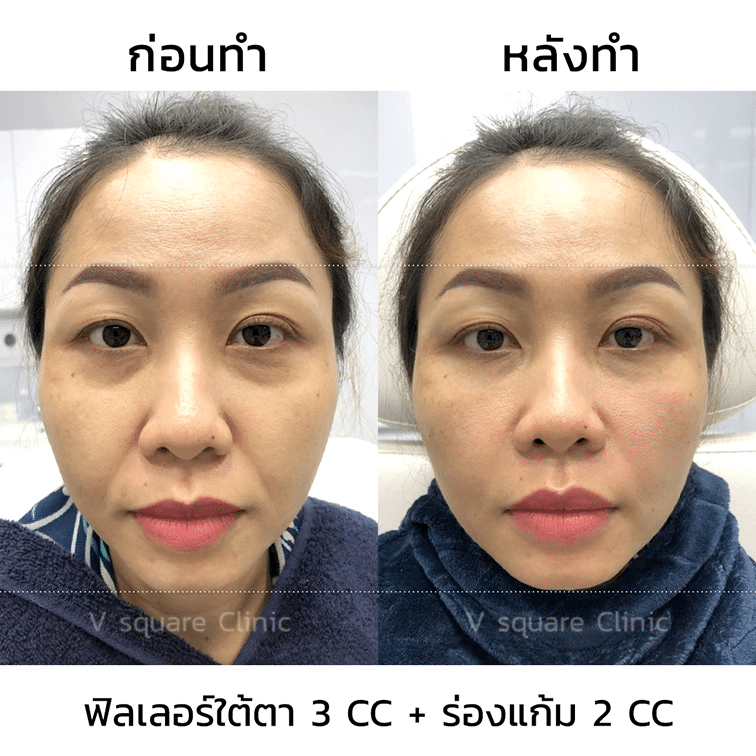 รีวิวฉีดฟิลเลอร์ร่องแก้ม