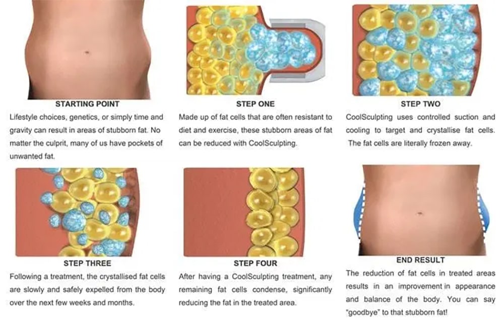 หลักการทำงานของ coolsculpting elite