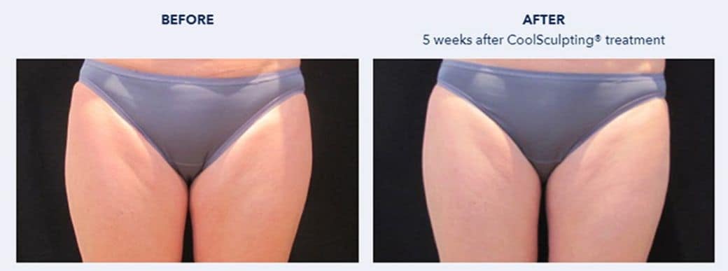 รีวิว Coolsculpting สลายไขมันต้นขา