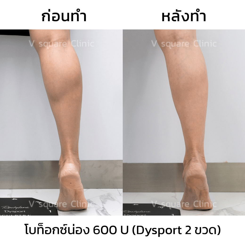 รีวิวฉีดโบท็อกน่อง_คุณแพร