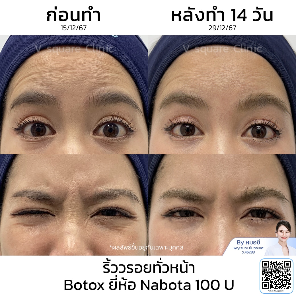 รีวิวฉีดโบท็อกเกาหลี ริ้วรอย_กุ๊กกิ๊ก โดยหมอ ซี