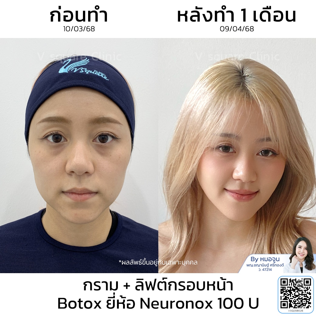 รีวิวโบท็อกเกาหลี_คุณดอลลาร์ โดยหมอ จูน