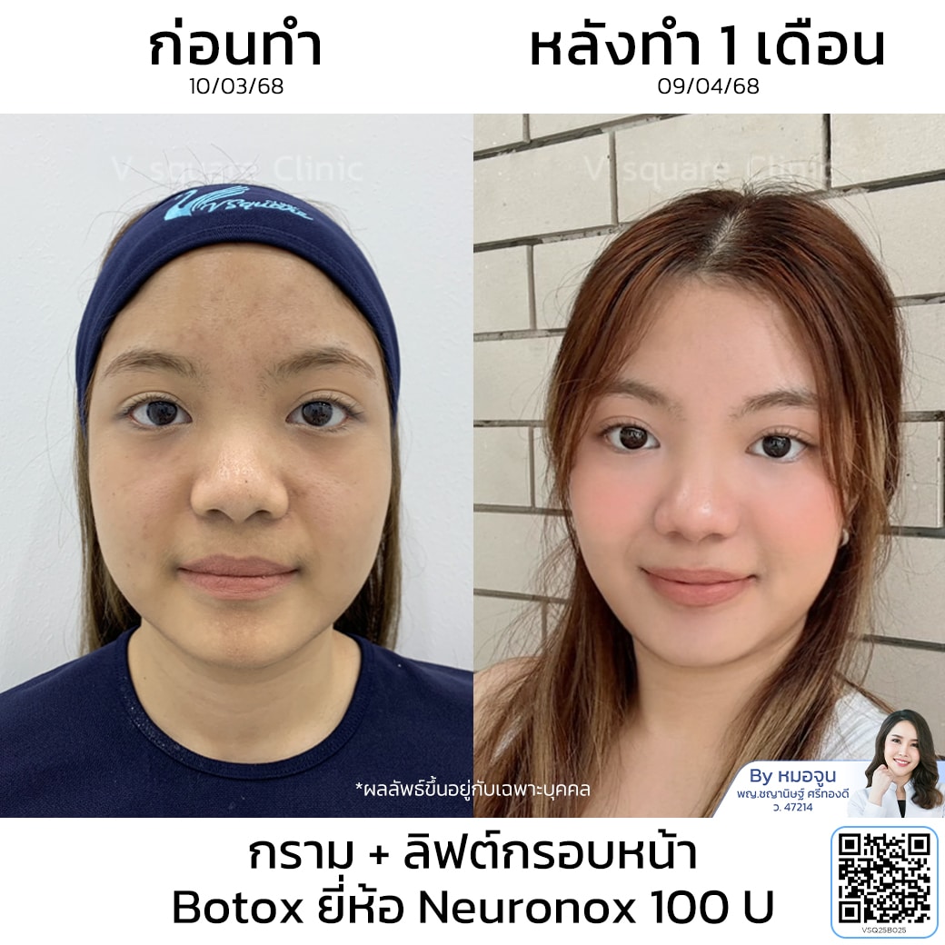 โบท็อกเกาหลี รีวิว_คุณฟา โดยหมอจูน