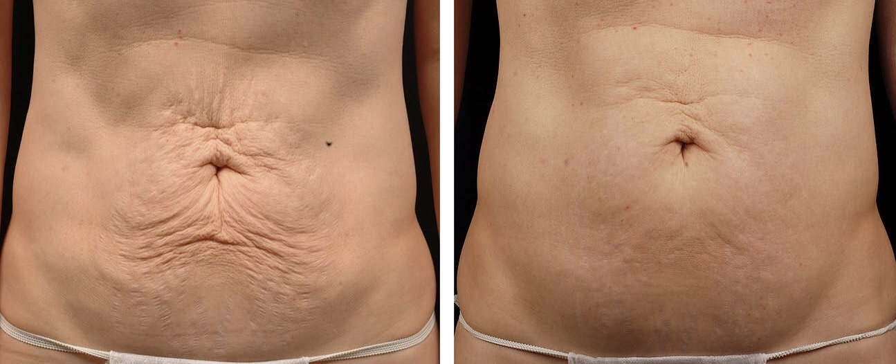 ตัวอย่างรีวิวผลการรักษาผิวหนังส่วนเกินชั้นตื้นบริเวณหน้าท้องด้วย Thermage FLX For Body