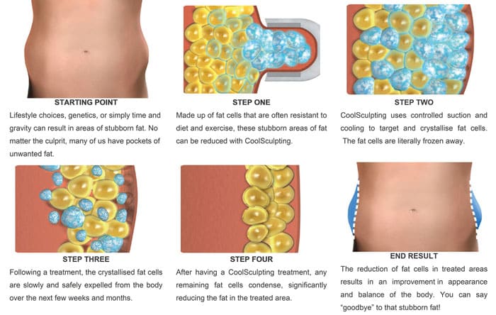 ผลการรักษา-Coolsculpting