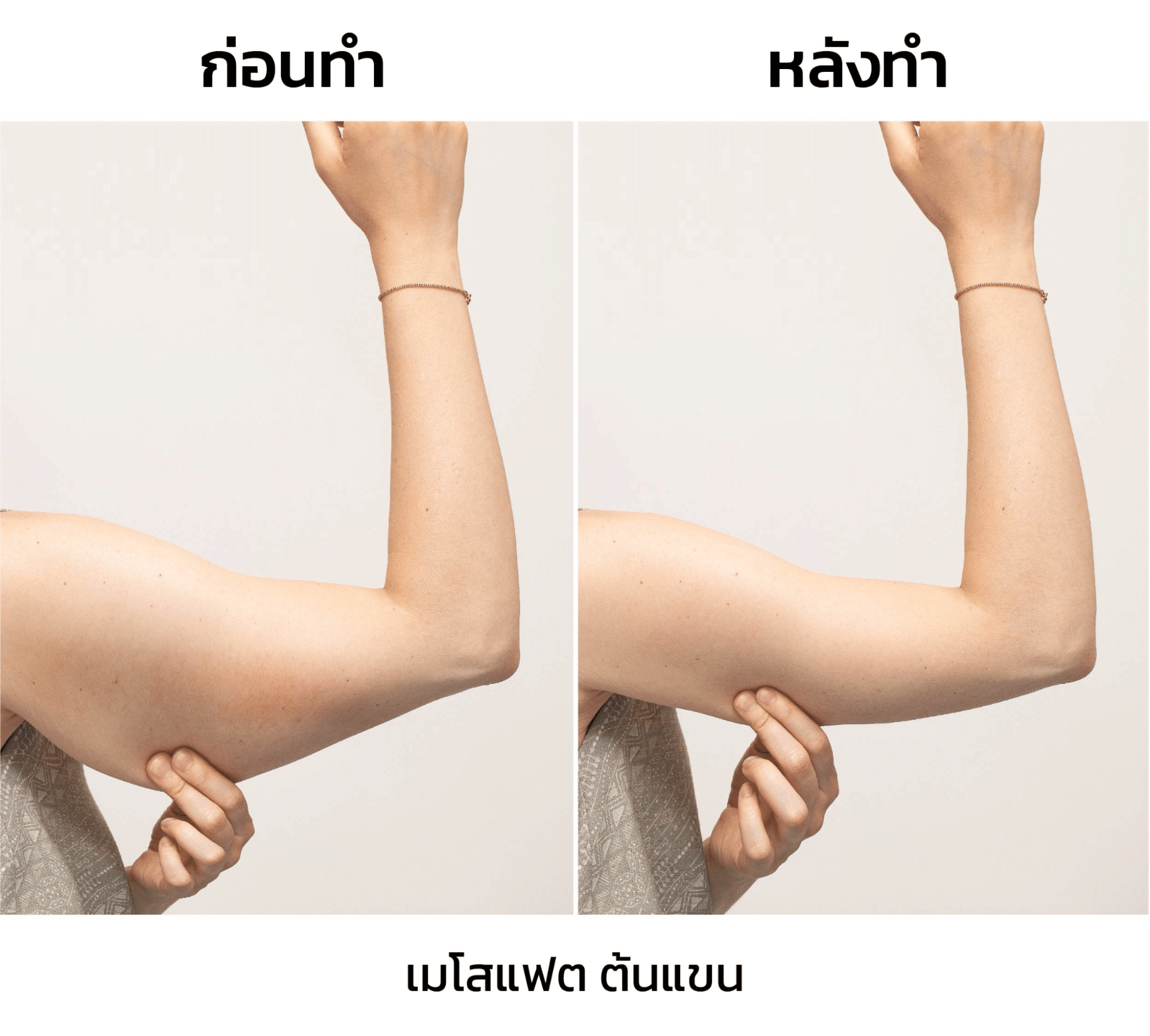 รีวิวฉีดเมโสต้นแขน