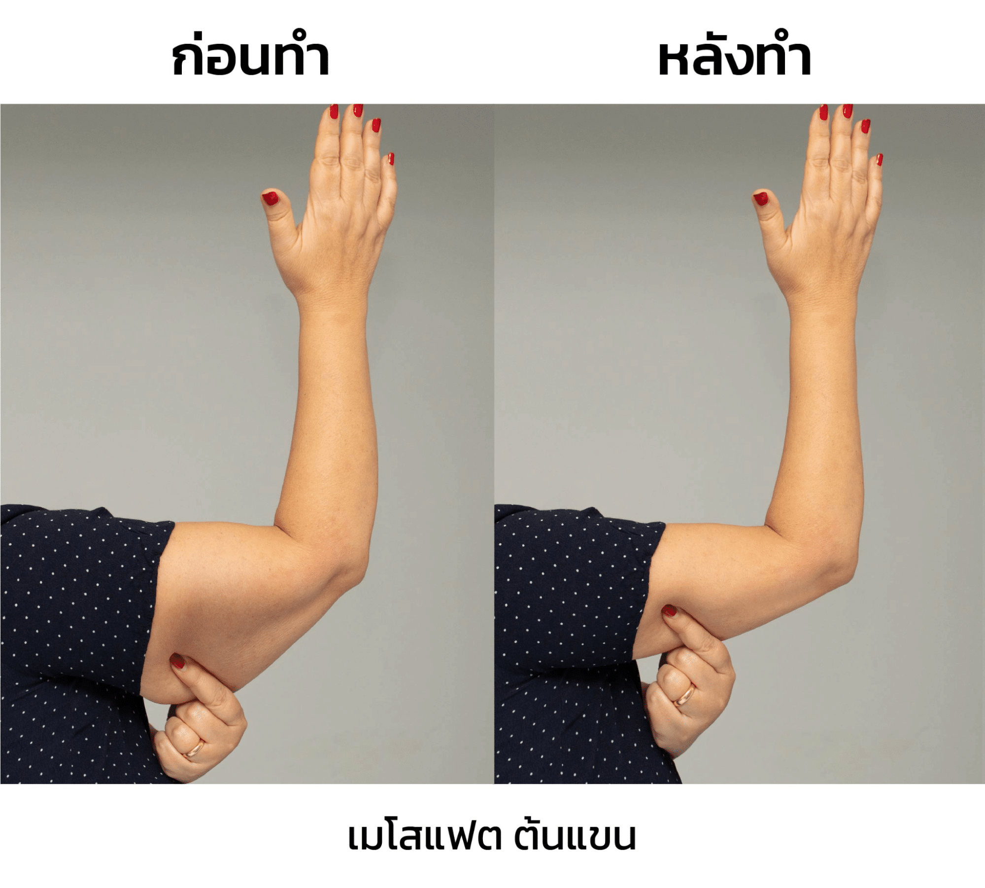 รีวิวฉีดเมโสต้นแขน(1)