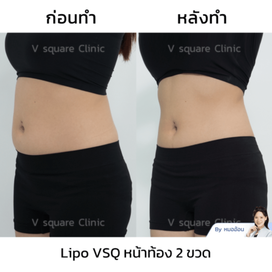 รีวิวฉีดเมโสแฟตหน้าท้อง_คุณแคท