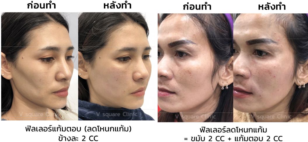 รีวิวฟิลเลอร์แก้มตอบ