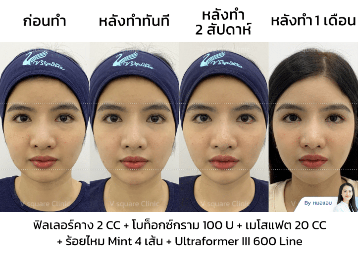 รีวิวเมโสแฟต_คุณซานตี้
