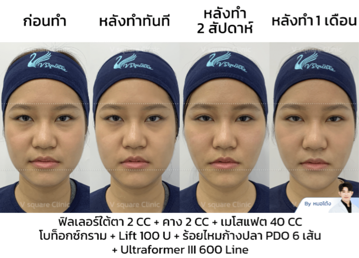 รีวิวเมโสแฟต_แจน