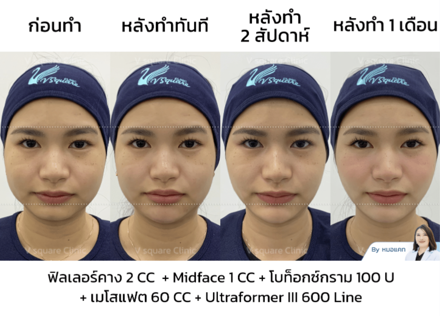 รีวิวโบท็อกกราม_คุณเนย