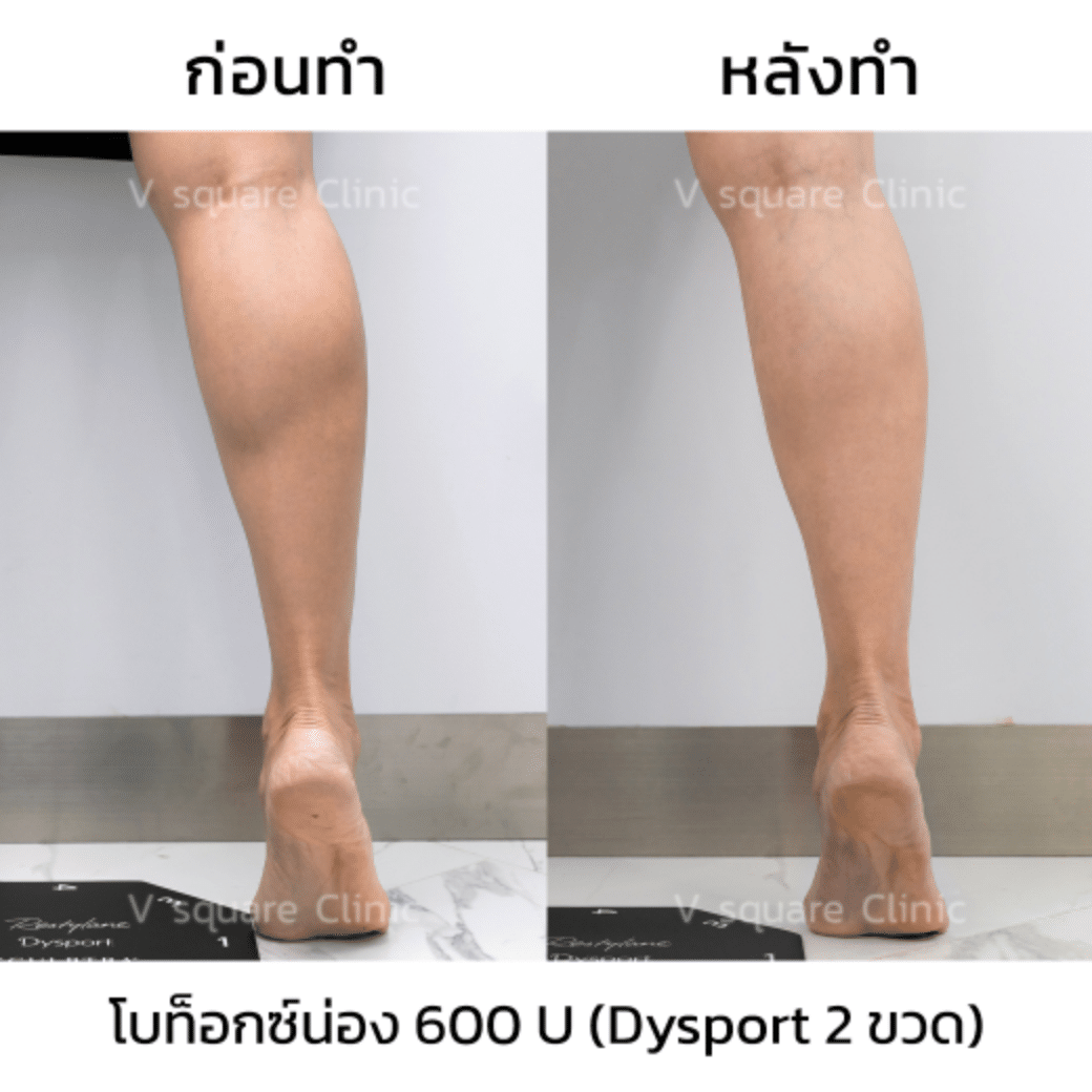 รีวิวโบท็อกลดน่อง_คุณแจน