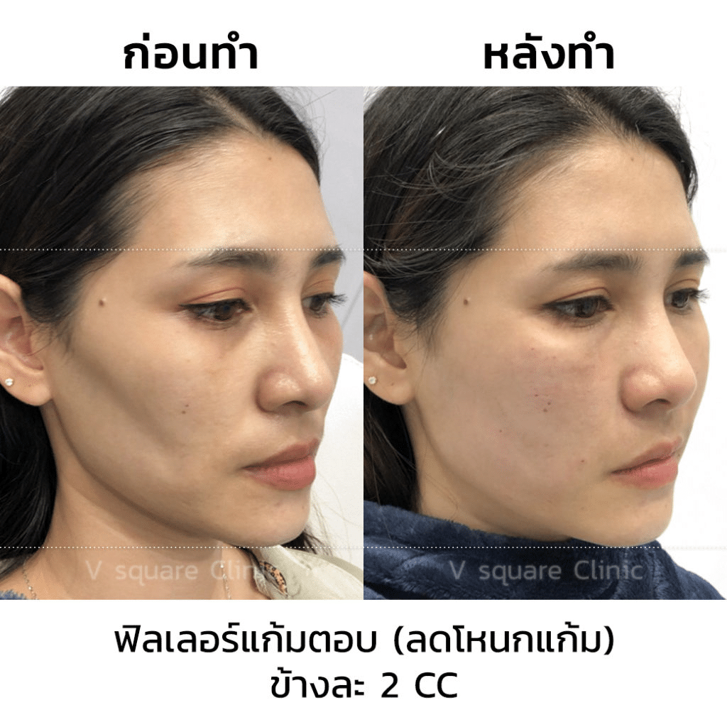 ฉีดฟิลเลอร์ลดโหนกแก้มสูง