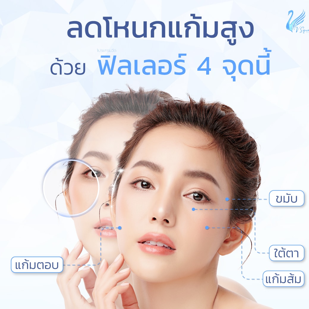 ลดโหนกแก้มสูงด้วยฟิลเลอร์