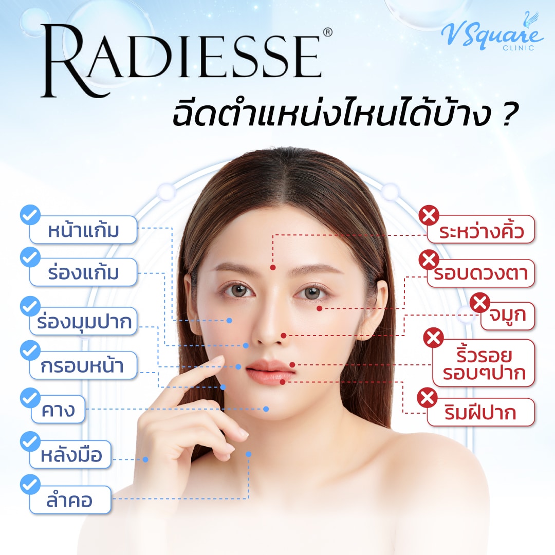 Radiesse Filler ตำแหน่งที่เหมาะ