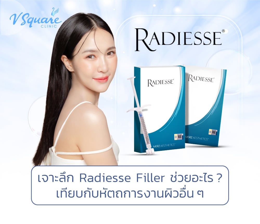 Radiesse Filler