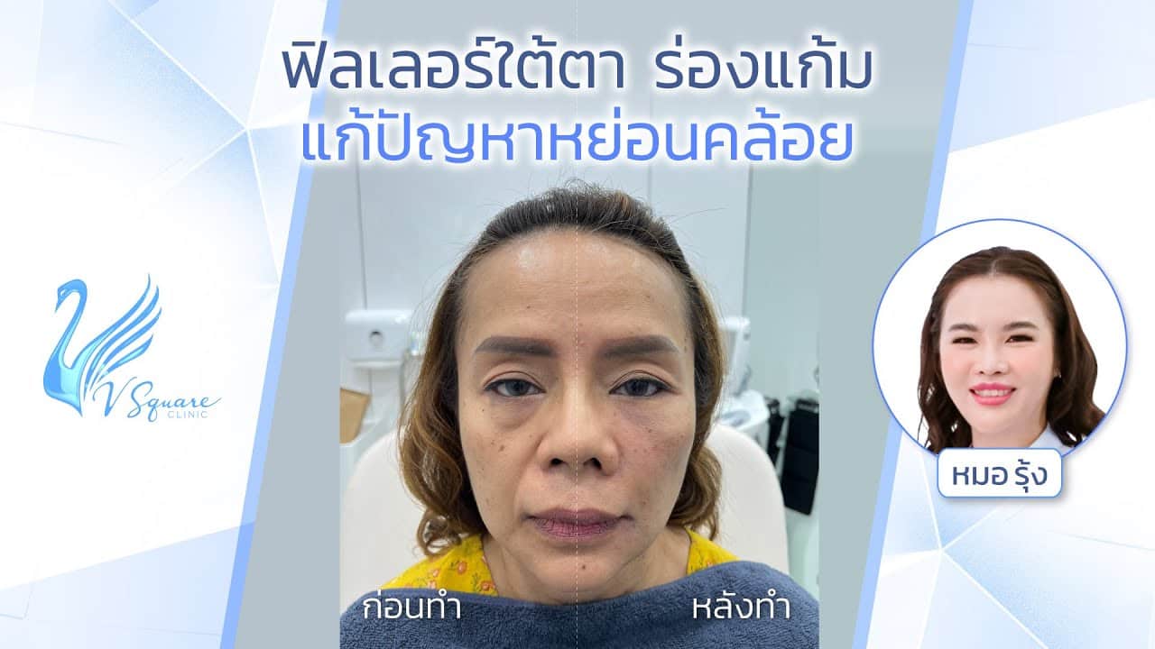 รีวิวยกกระชับใบหน้าด้วยเทคนิคฉีดฟิลเลอร์ by หมอรุ้ง