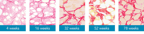 ผลลัพธ์หลังฉีด Radiesse filler