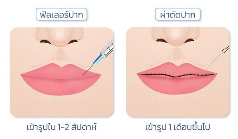 ฟิลเลอร์ปาก vs ผ่าตัดปาก