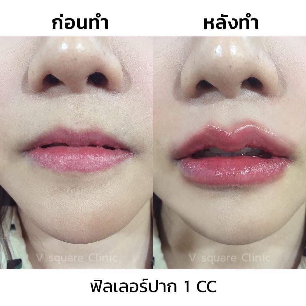 รีวิวฟิลเลอร์ปาก 1 cc