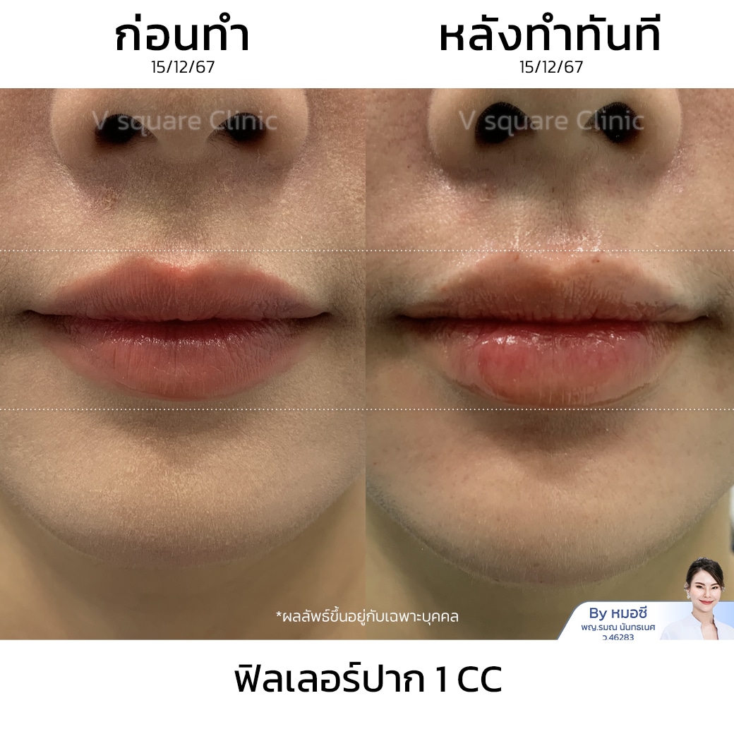 รีวิวฟิลเลอร์ปาก 1 cc(1)