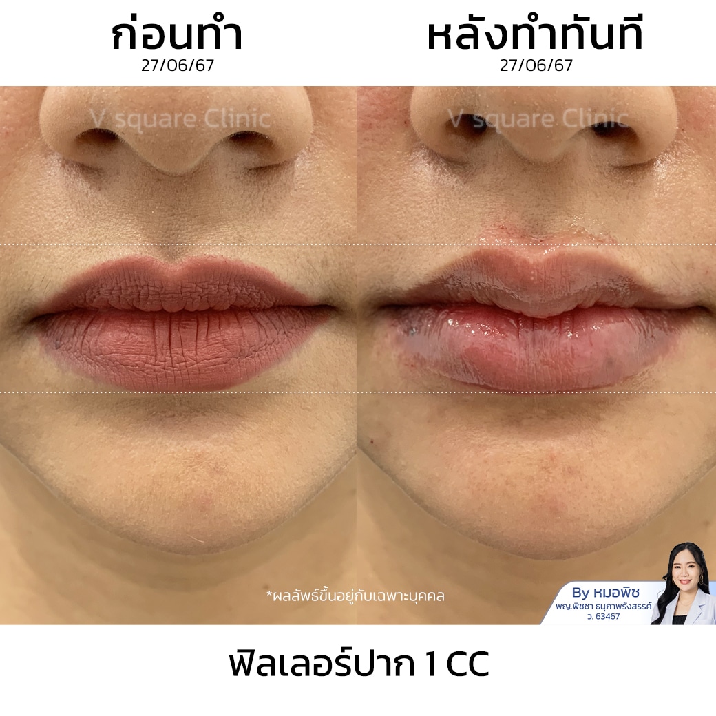 รีวิวฟิลเลอร์ปาก