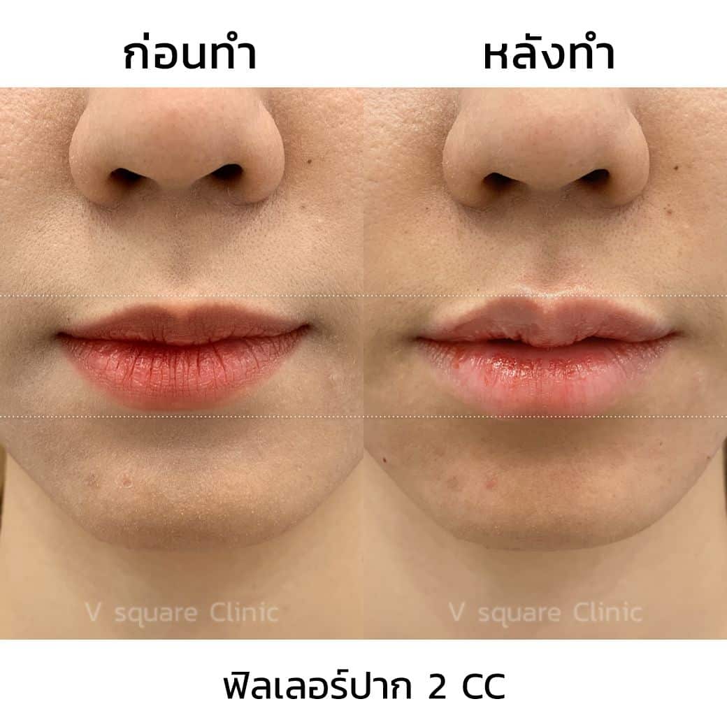 รีวิวฟิลเลอร์ปาก 2 cc