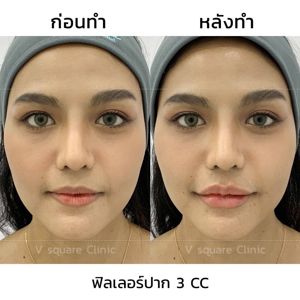 รีวิวฟิลเลอร์ปาก 3 cc