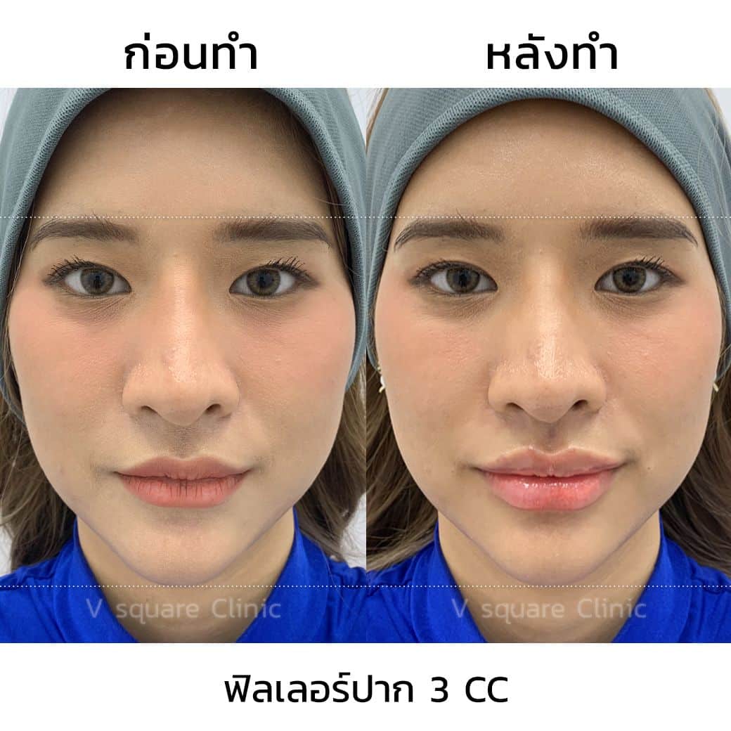 รีวิวฟิลเลอร์ปาก