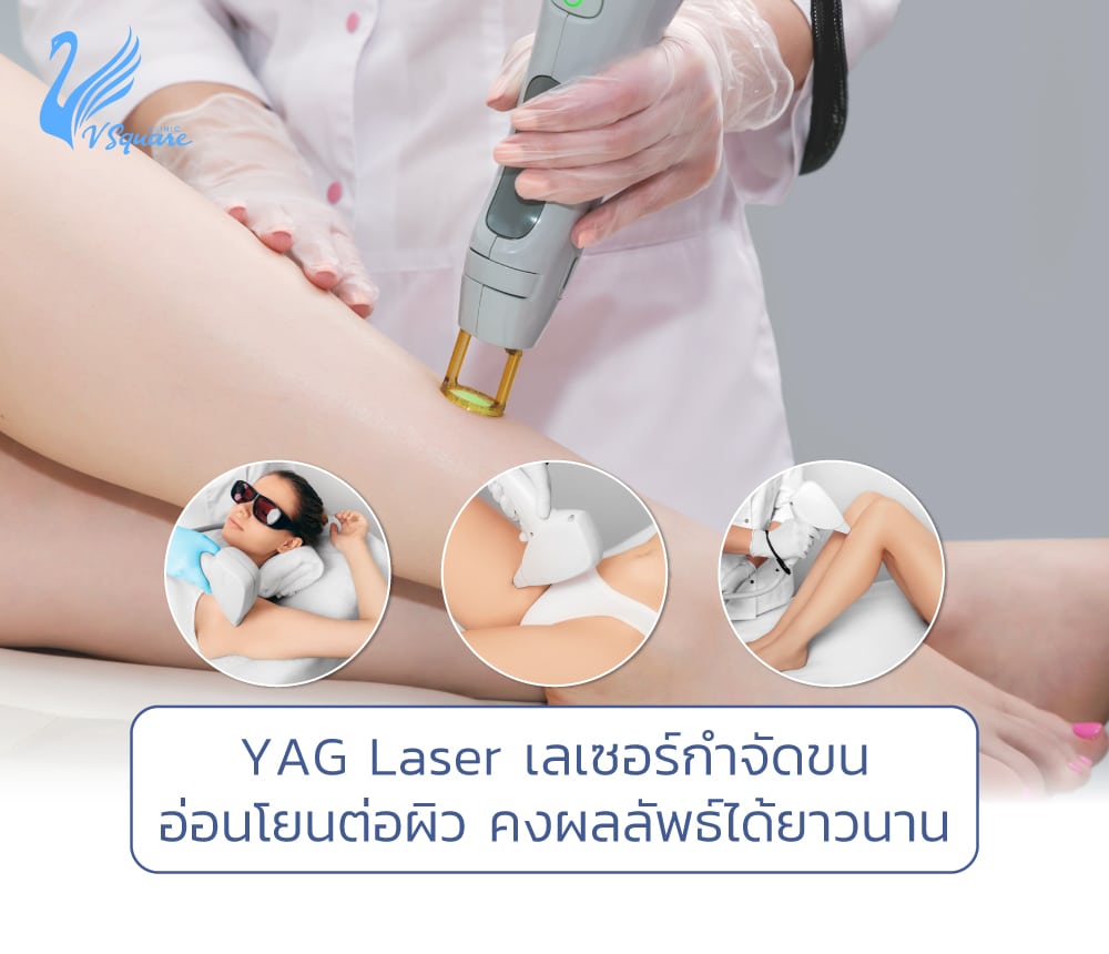 YAG Laser