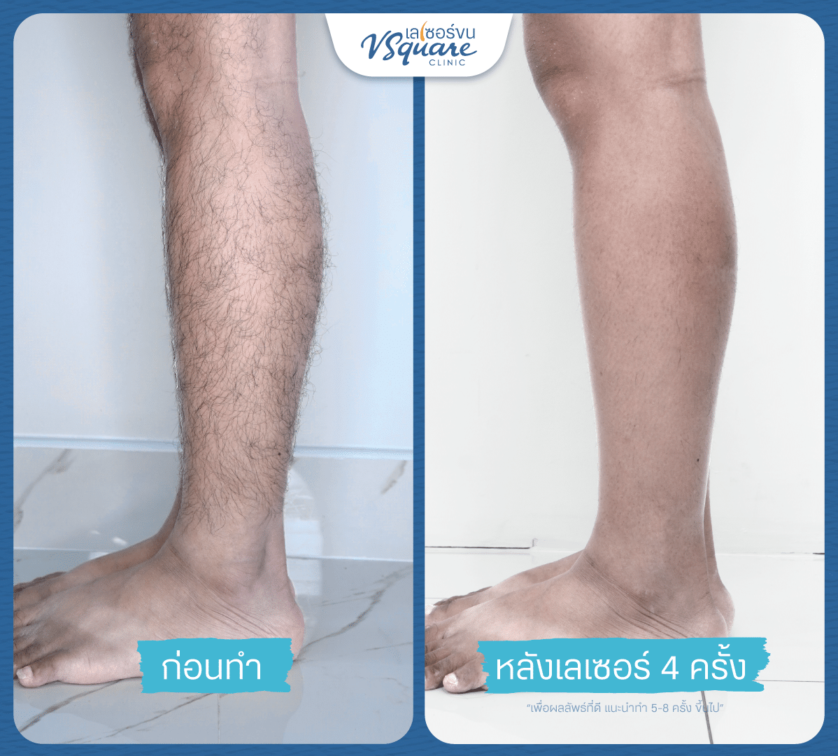 เลเซอร์ขนขา รีวิว