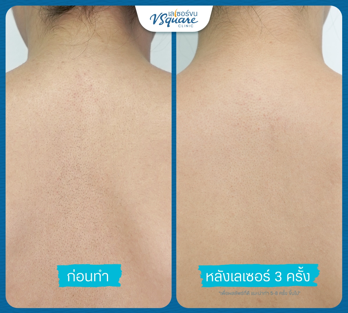 เลเซอร์ขนหลัง รีวิว