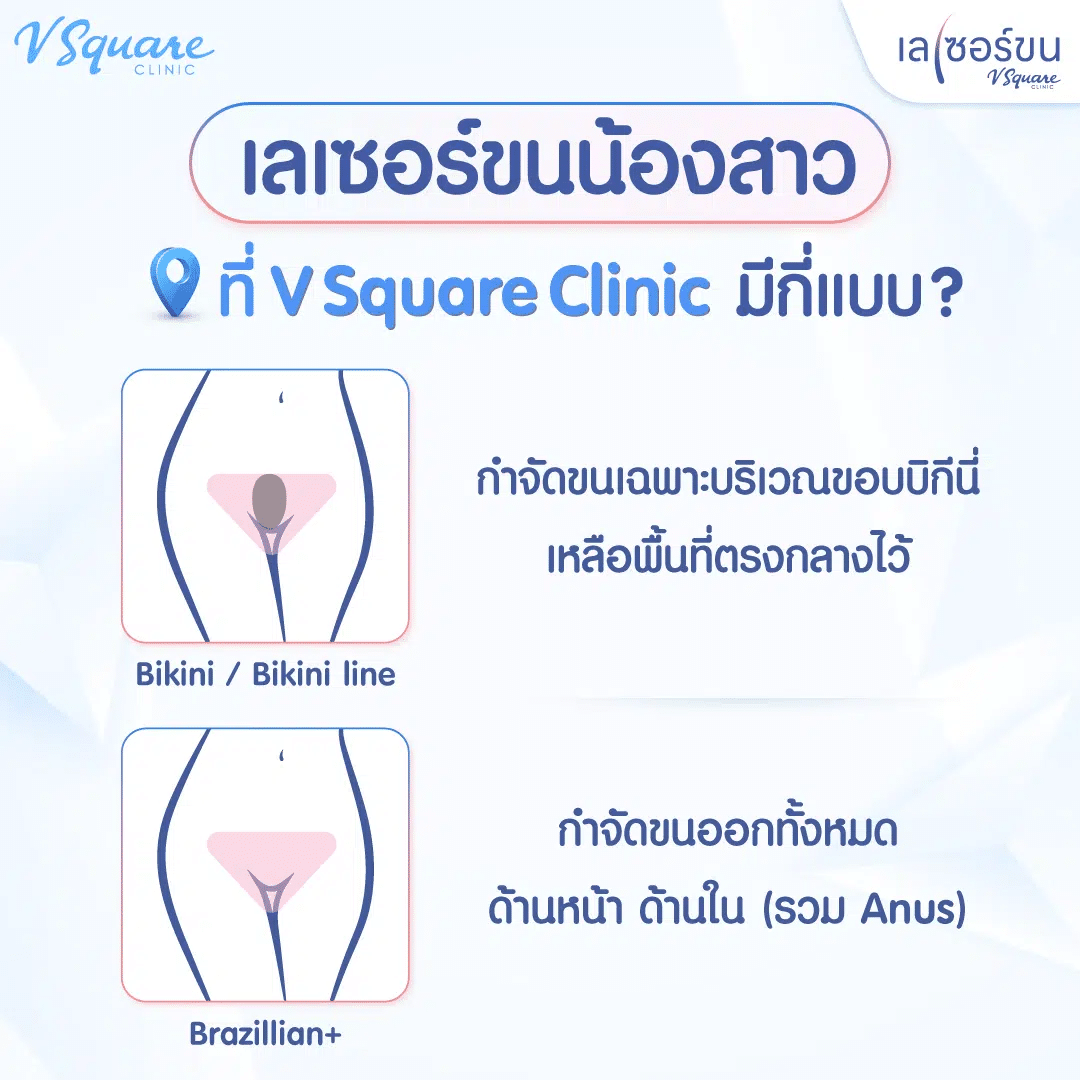 เลเซอร์ขนน้องสาว ที่ V Square Clinic