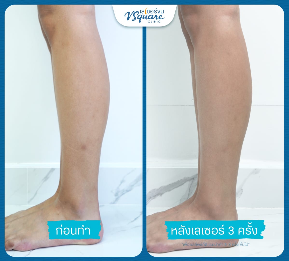 เลเซอร์ขนขา รีวิว