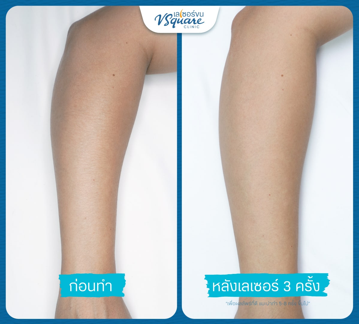 เลเซอร์ขนแขน รีวิว