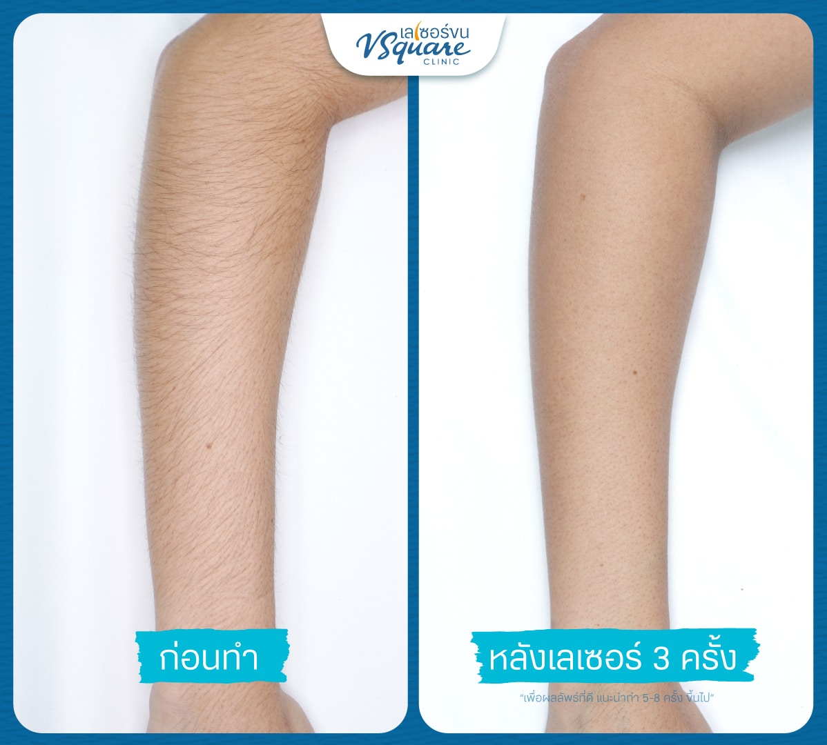 เลเซอร์ขนแขน รีวิว